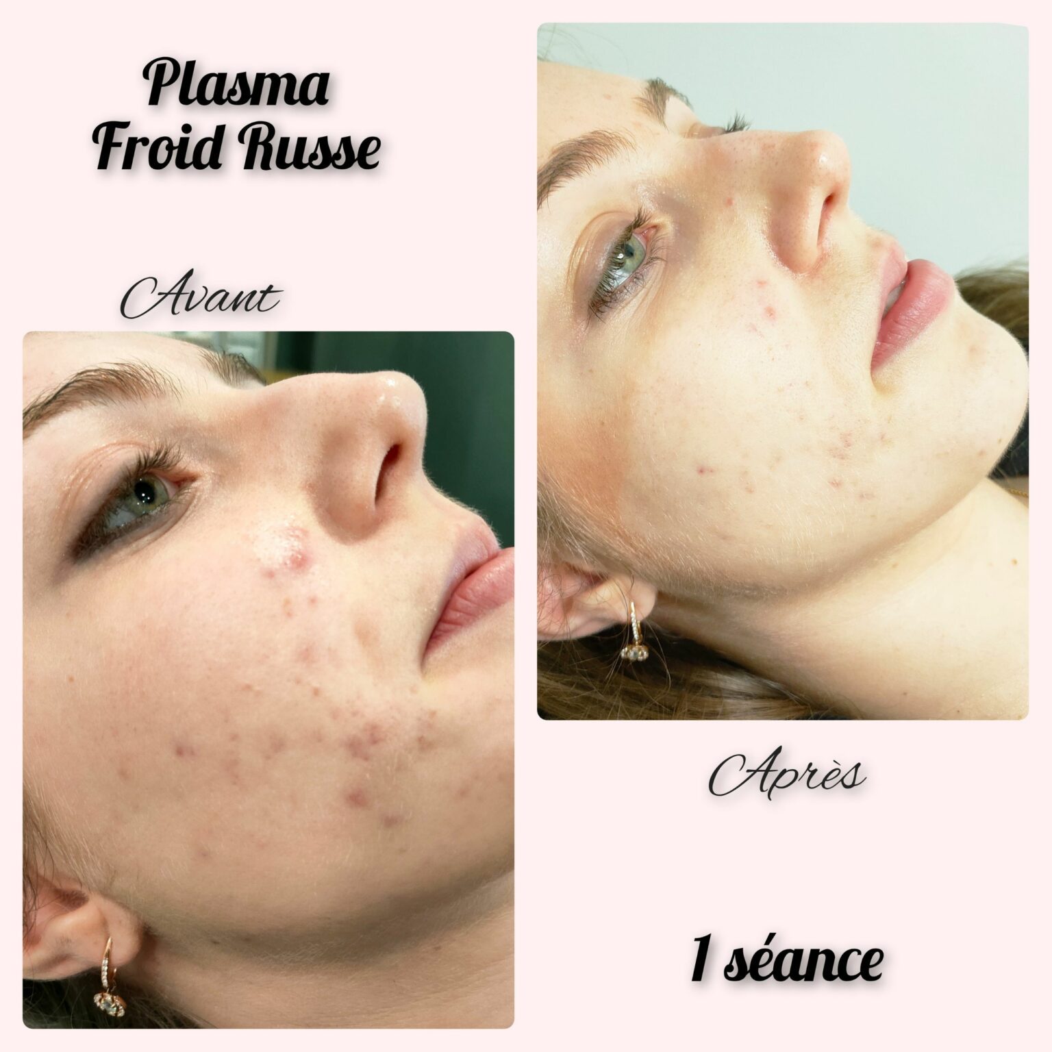 plasma russe natacha beauté 4